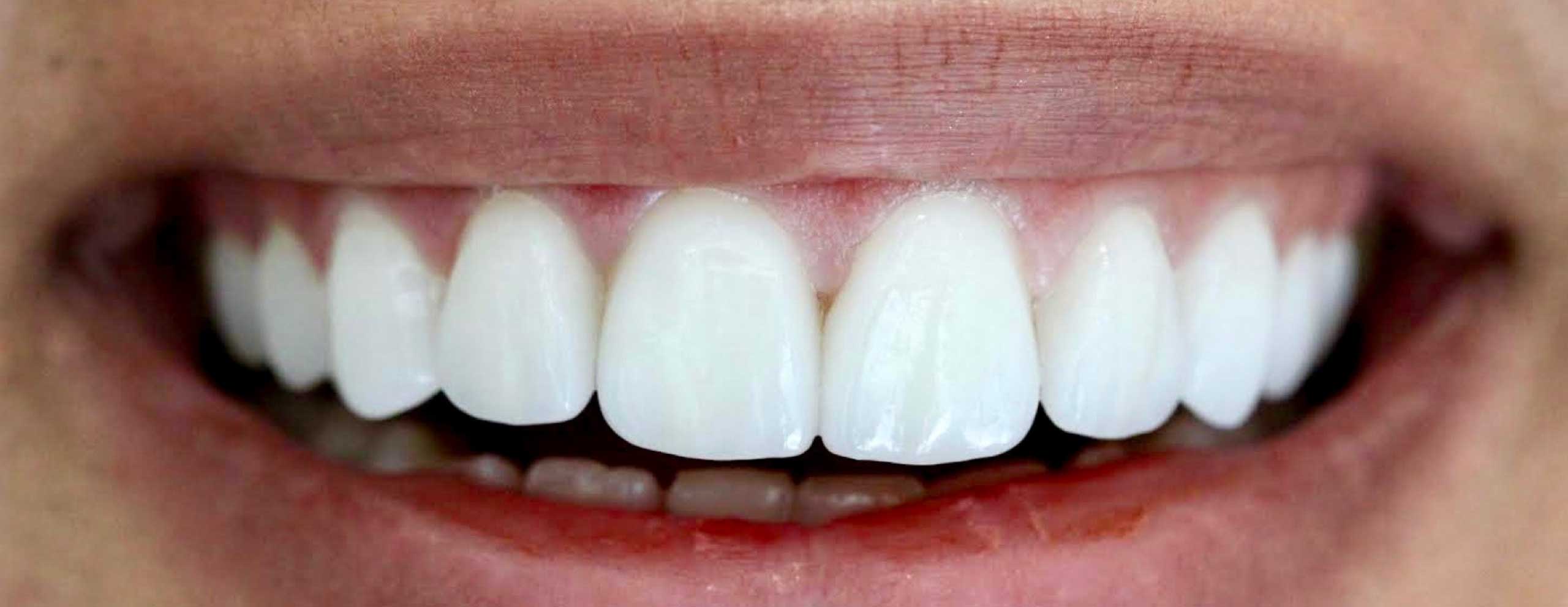 teeth whitening strips